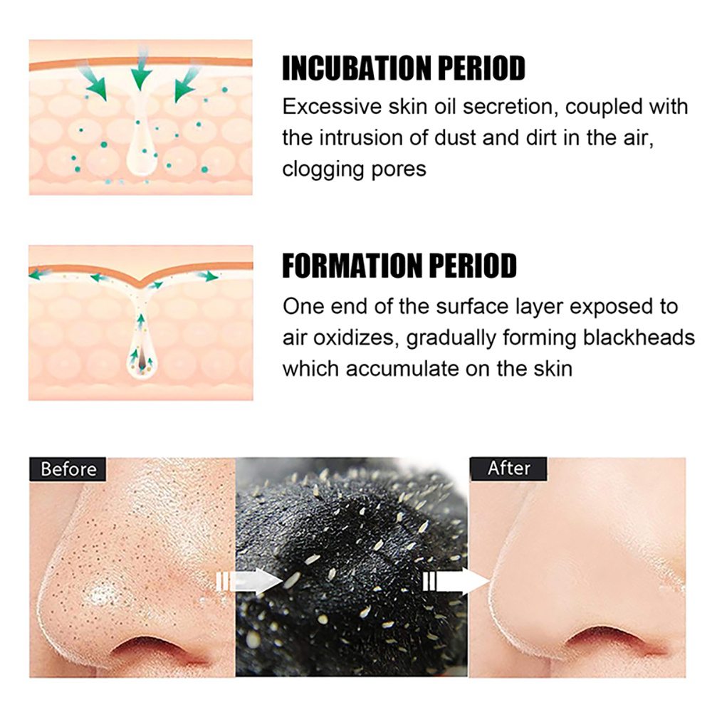 10-100Pcs Blackhead Remover Ma - đánh giá và giá Nasal Aspirator